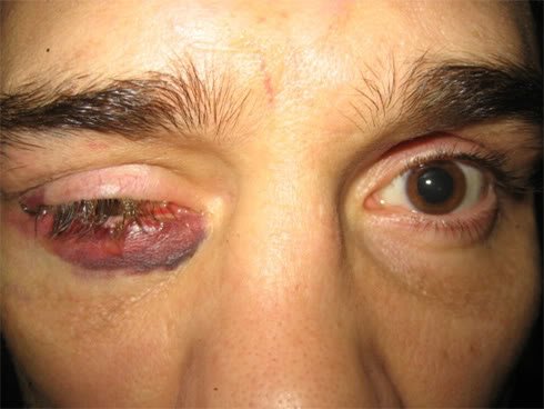 rich_franklin_eye_poke1