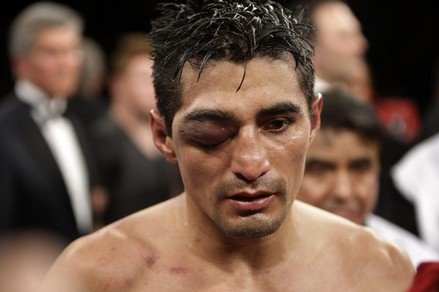 The 10 Worst Black Eyes Of All Time