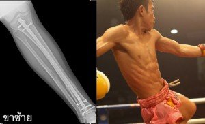 thai-shin-implant-660x400 copy