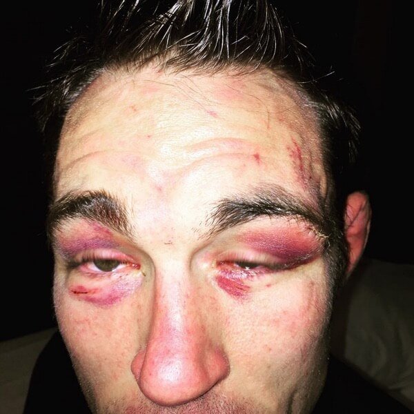 Jake Shields' eyes after the fight. The result of many blatant eye gouging attempts by Rousimar Palhares. 