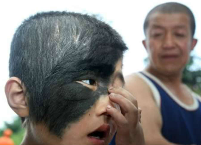 Eight-Year-Old-Chinese-Boy-Receives-Free-Eye-Surgery-to-Remove-Hairy-Birthmark