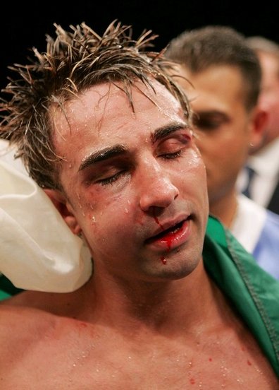 Malignaggi's face after the Cotto fight