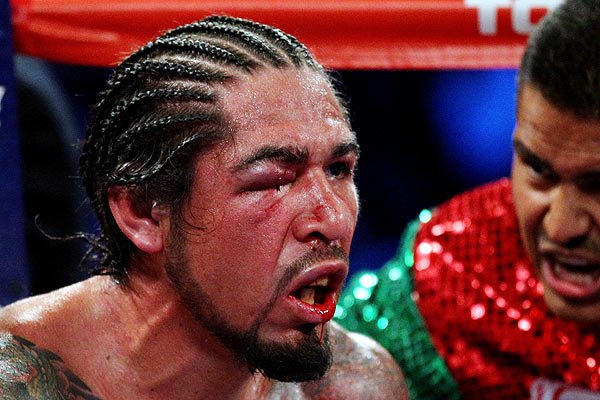 Margarito after the facing the Pacman
