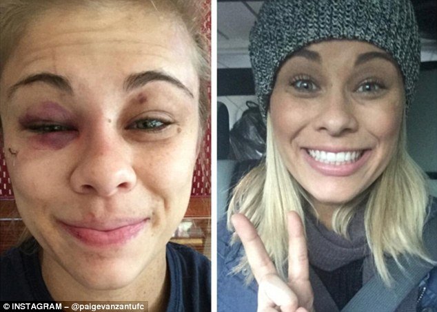 2F80267C00000578-0-Paige_VanZant_s_face_after_being_stitched_up_post_fight_left_com-a-23_1450523826233