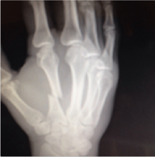 Ryan Bader broke the hell out of his hand when he destroyed Anthony Perosh in 2013. X-Ray taken from his Instagram account.
