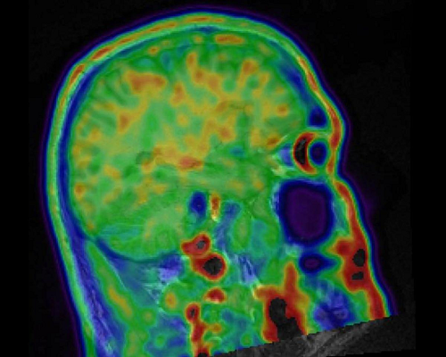 This is a scan of a 39 year-old former football player's brain. The yellow and orange splotches are sites of traumatic brain injuries. Photo by New York Daily News.